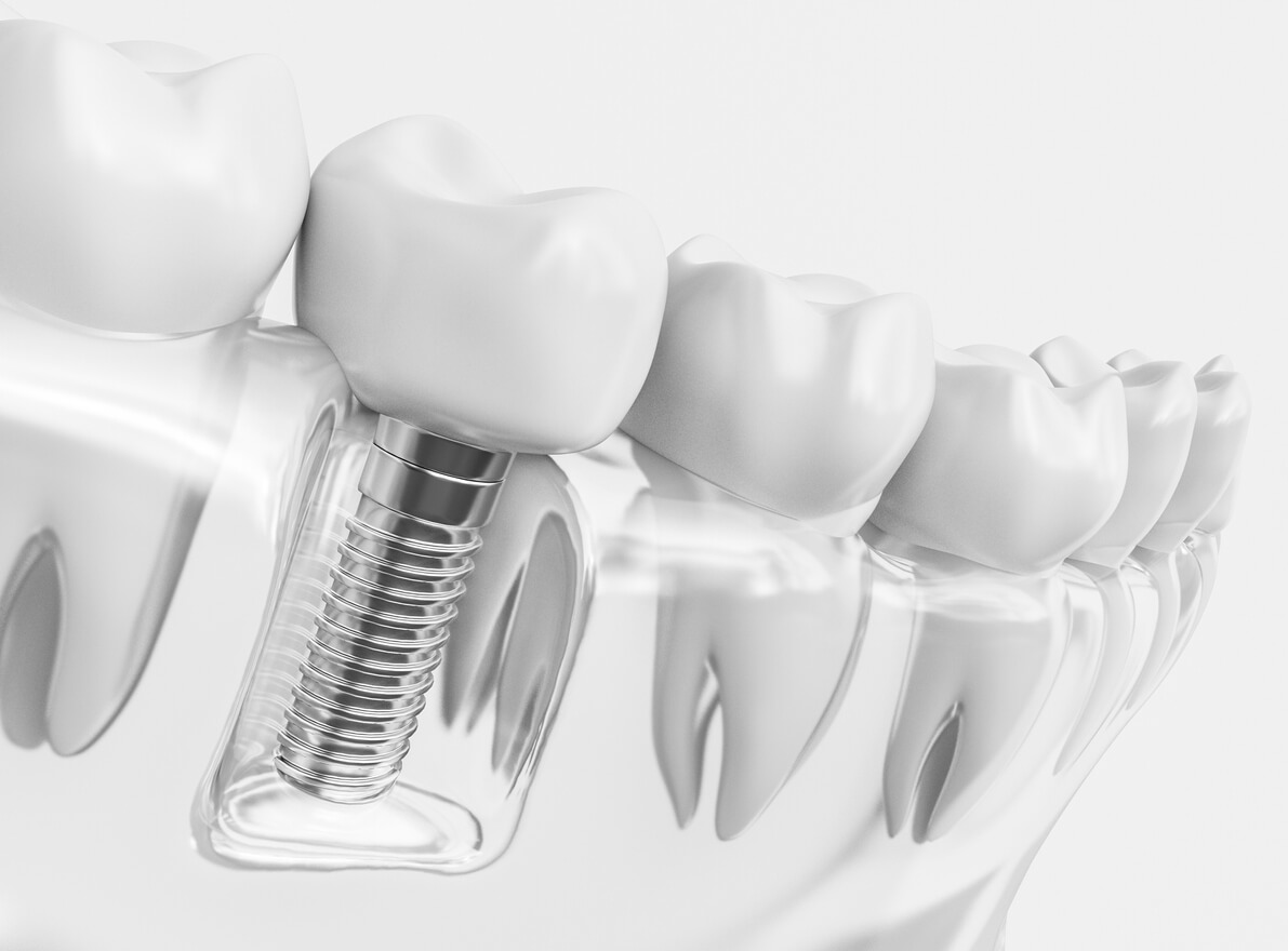 The Pros And Cons Of Dental Implants And Dental Crowns